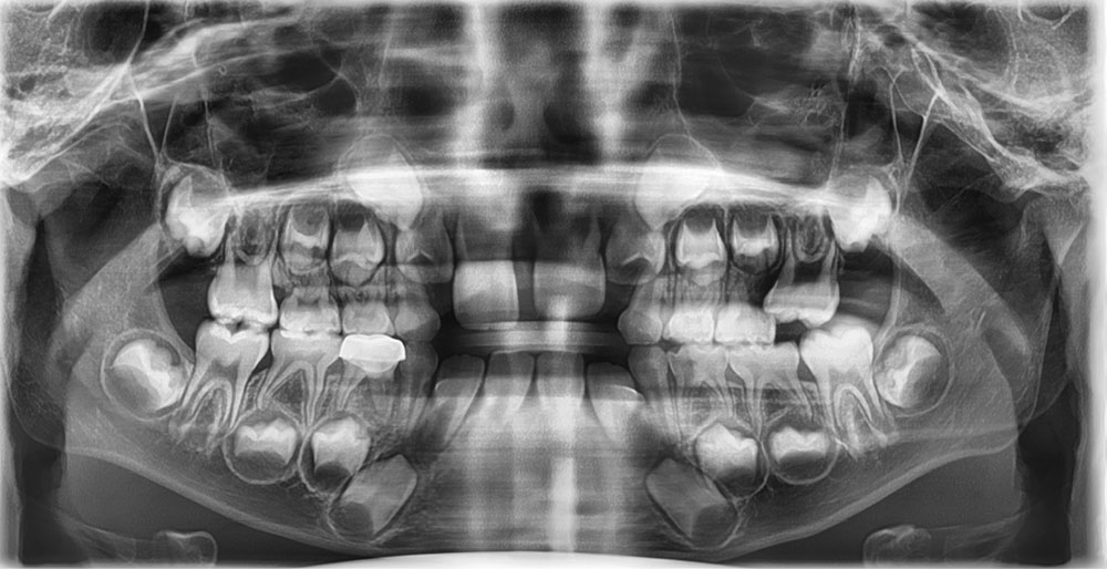 #26 mesial locking, 하악왜소, 영구치 맹출공간 부족