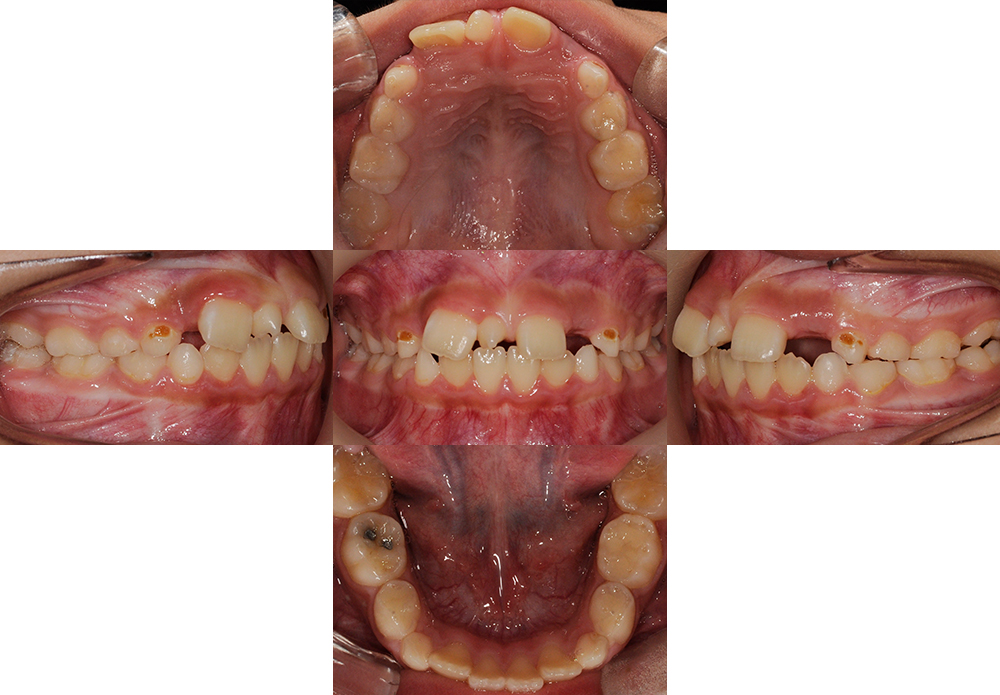 상악 정중 과잉치, 앞니 벌어짐, 영구치 맹출공간 부족