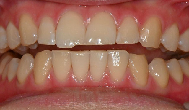 상악 중절치 법랑질 성형술(incisal enameloplasty)