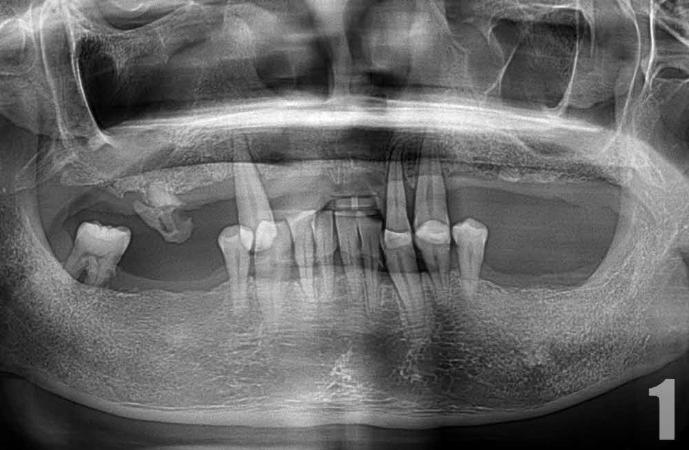 상하악 거의 전체 발치 후 임플란트