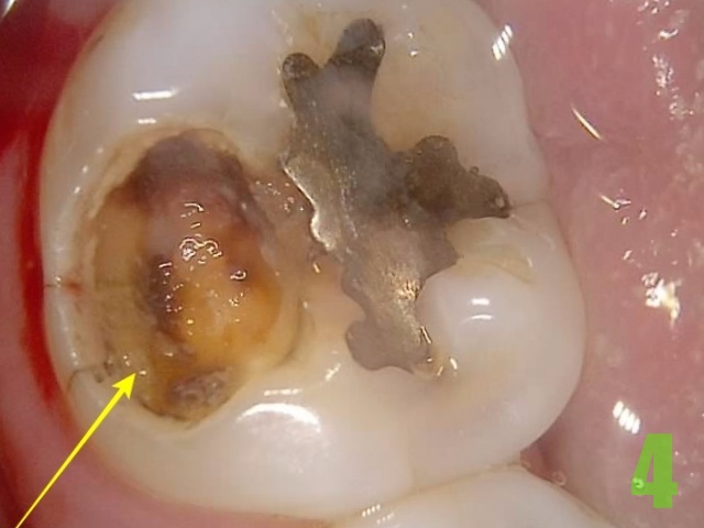 아말감 파절, 2차우식 - 크라운 치료