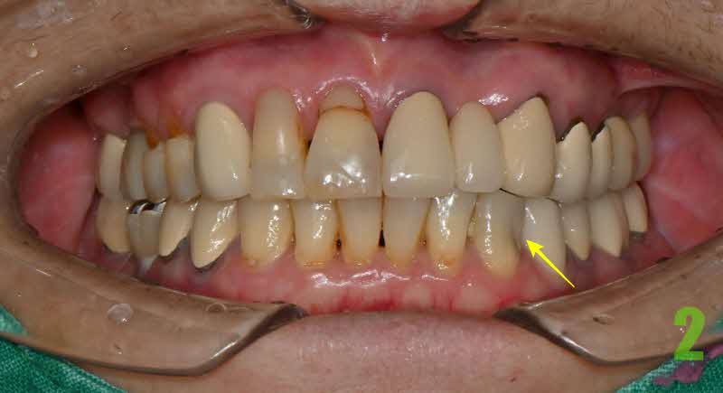 충치료 인해 신경치료 후 아래쪽 송곳니 크라운