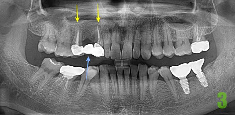 브릿지 보철 탈락, 심한 충치로 임플란트 3개 식립