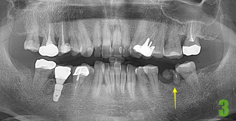 뿌리만 남은 치아 발치 후 임플란트