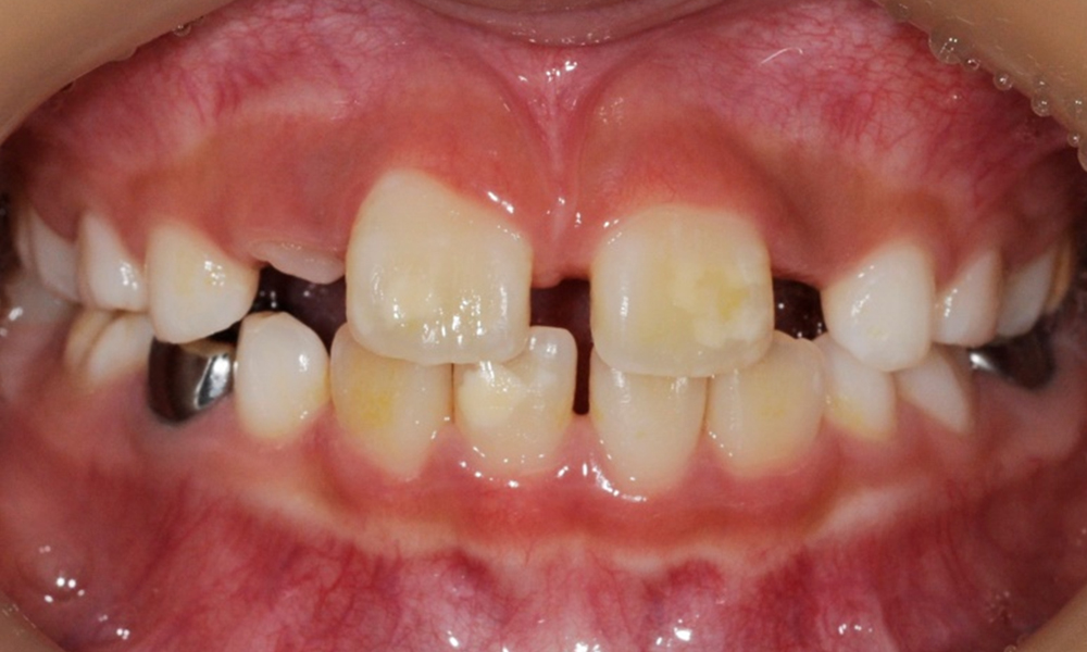 앞니가 벌어져서 나오는 환자-소아교정 치료전후