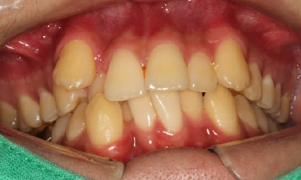부정교합 치료전후