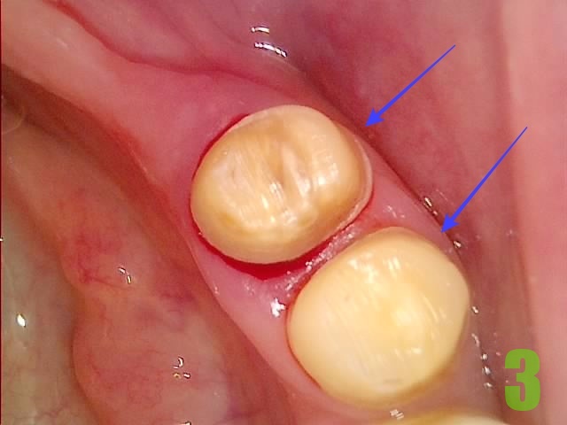 3. #34,35 보철 탈락.jpg