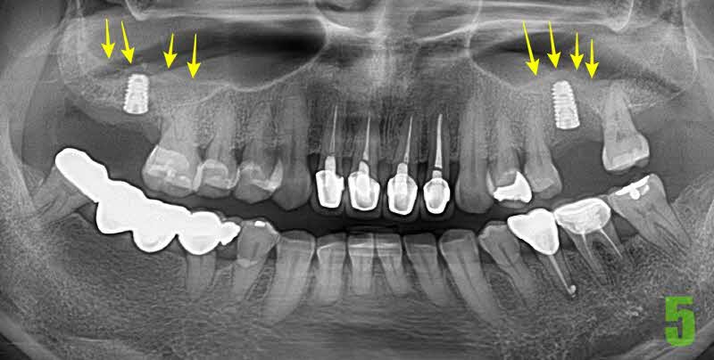 5. 임플 심은후 4개월_s.jpg