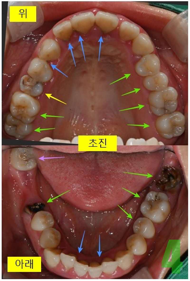 4. 초진 상하악_s.jpg