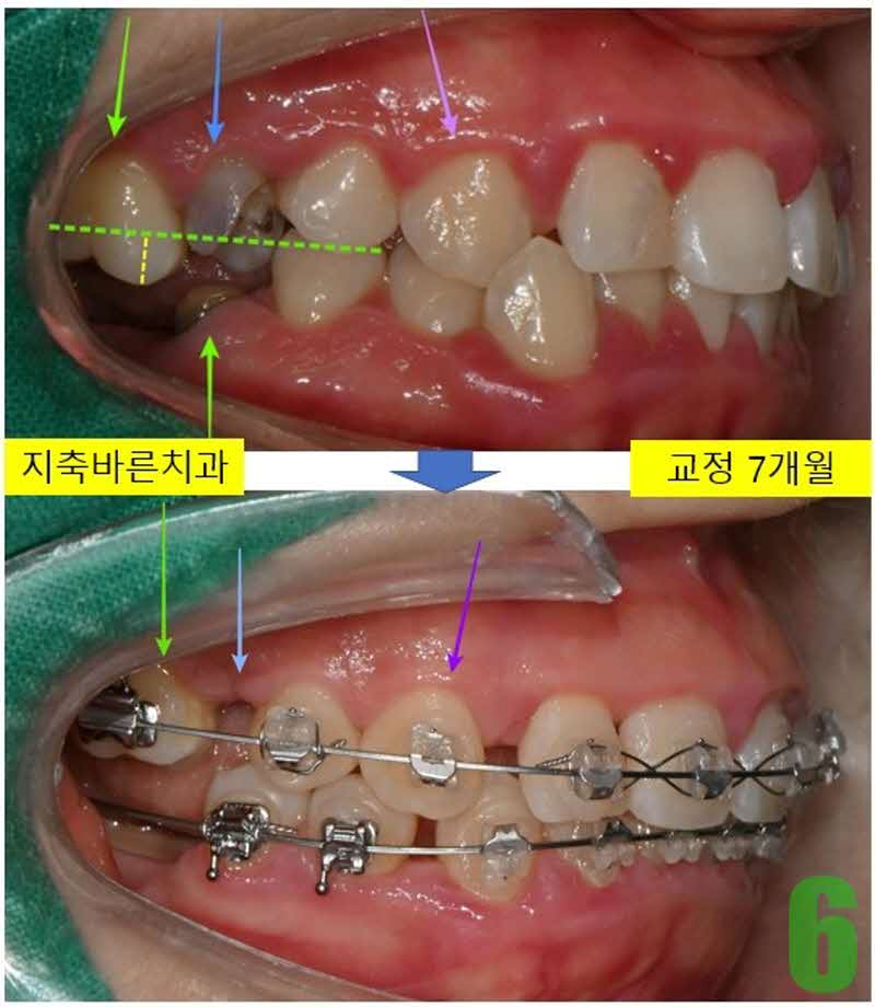 6. 치료전후 우측_s.jpg