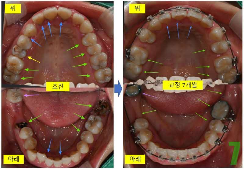 7. 치료 7개월 교합면_s.jpg