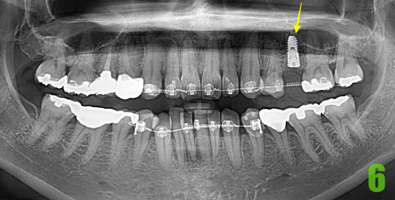 6. 발치후 1개월 후 임플 식립_s.jpg