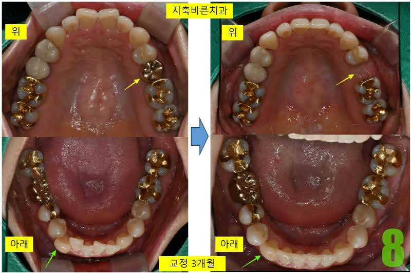 8. 교정 3개월 상하악_s.jpg