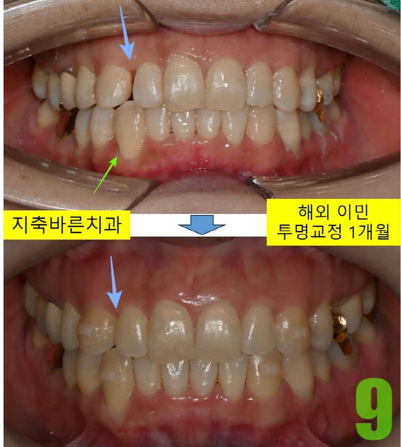 9. 1개월 투명교정 정면_s.jpg