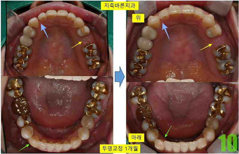 10. 이민 1개월 투명교정 상하악_s.jpg