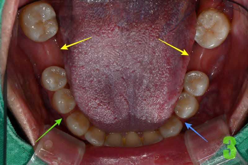 3. 초진 하악 교합면_s.jpg