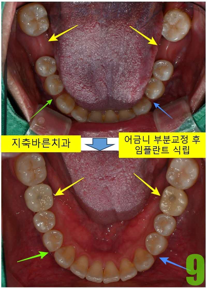 9. 치료전후 하악_s.jpg