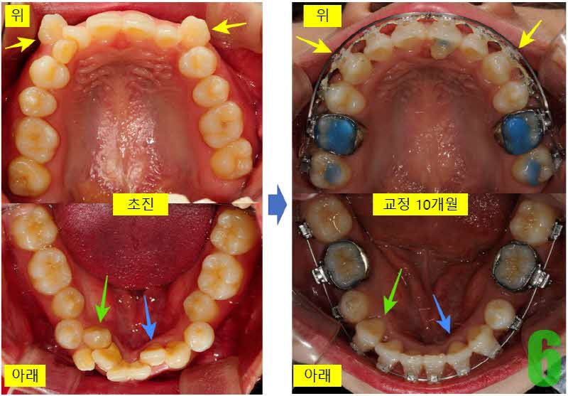 6. 10개월 상하악_s.JPG