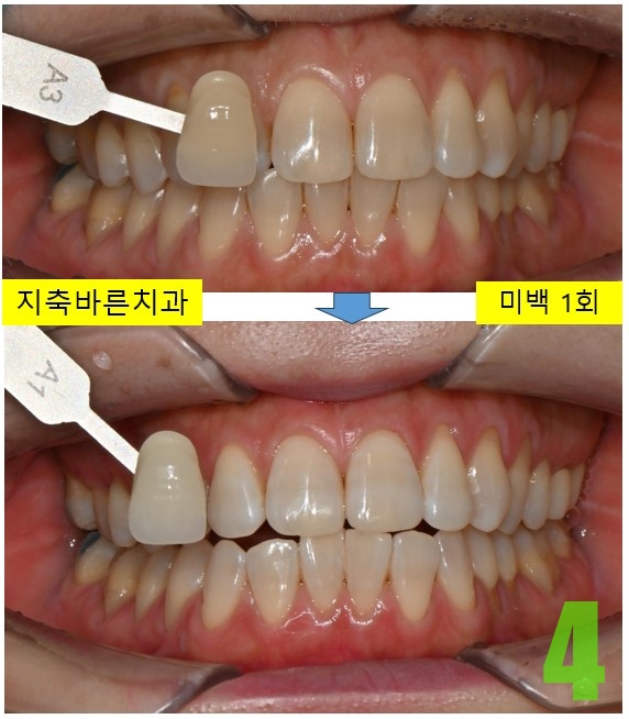 4. 미백 1회.jpg