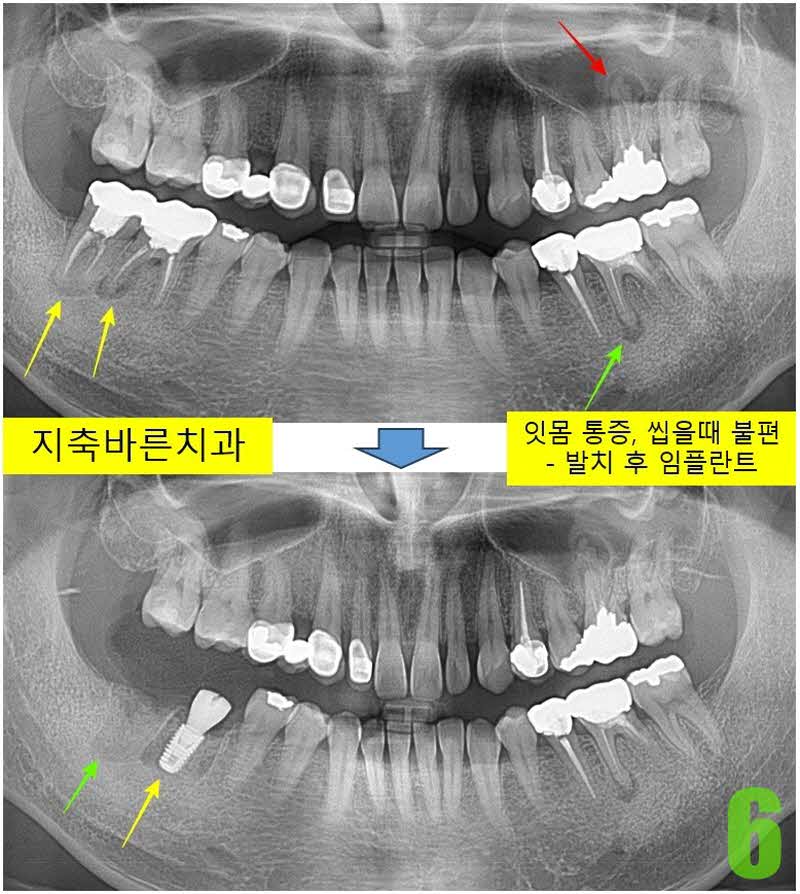 6. 임플 식립_s.jpg