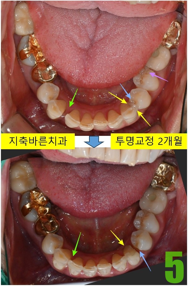 5. 치료 2개월.jpg