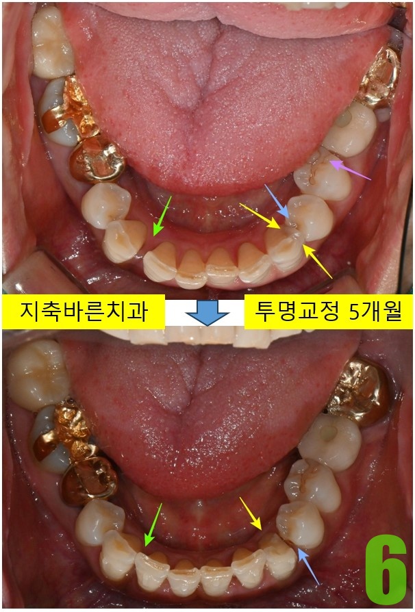 6. 치료 5개월.jpg