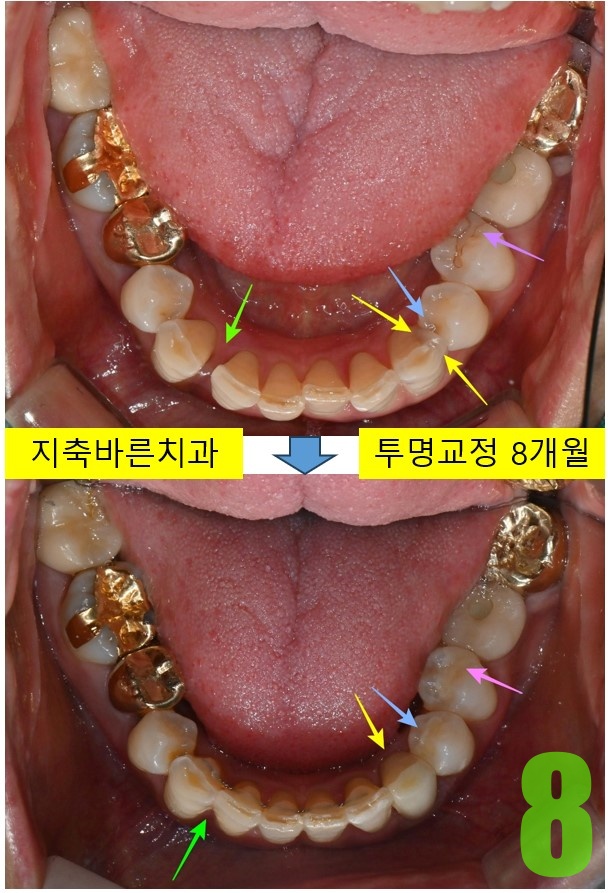 8. 디본딩 하악.jpg