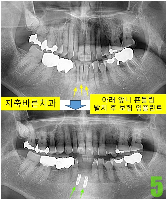 5. 임플 식립 후.jpg