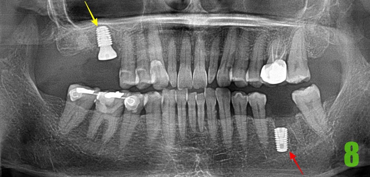 8. #36 임플란트 식립.jpg