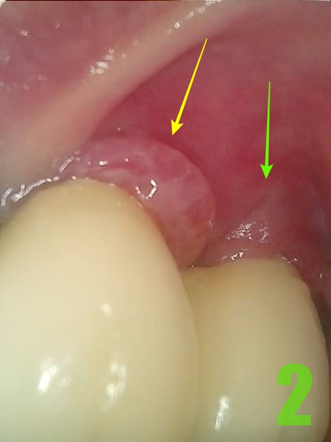 2. #26,27 임플란트 주위염.jpg