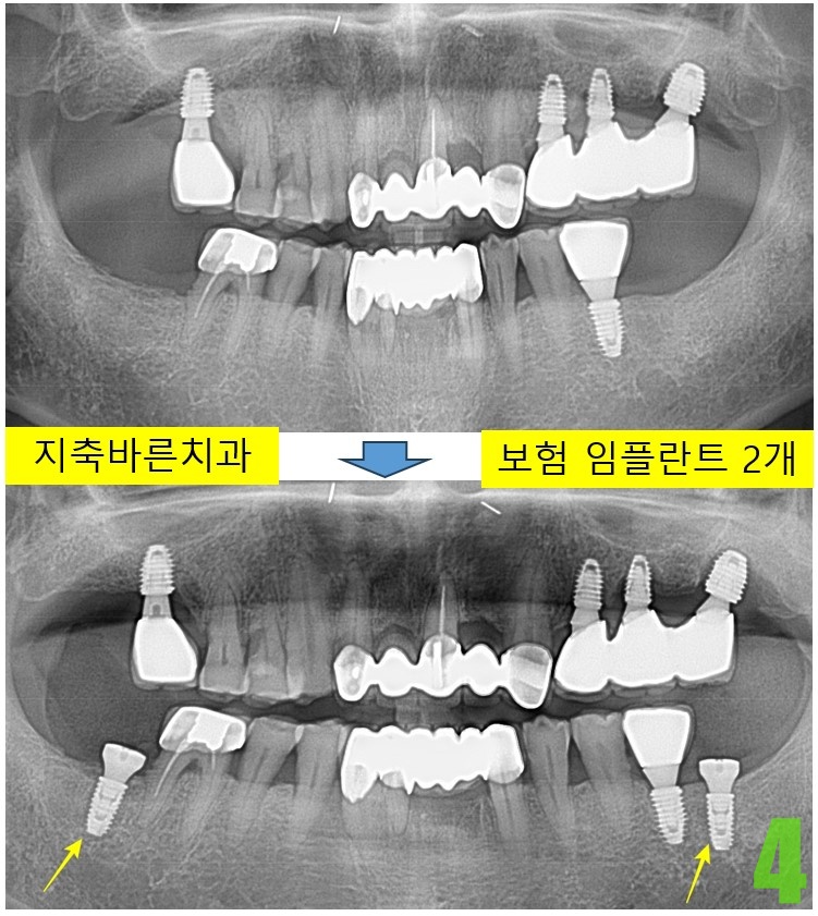 4. 임플 식립.jpg