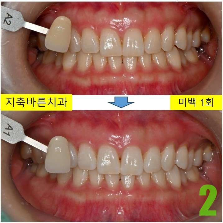 2. 미백 1회.jpg