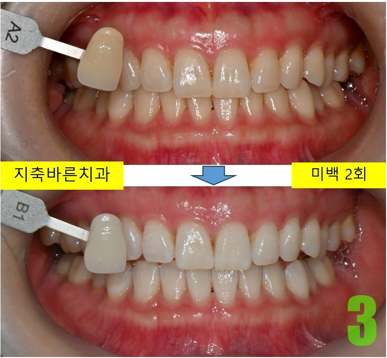 3. 미백 2회.jpg