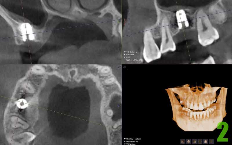 2. 임플란트 제거 초진사진 CT_s.jpg