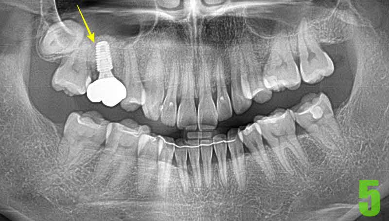 5. 임플란트 완성_s.jpg