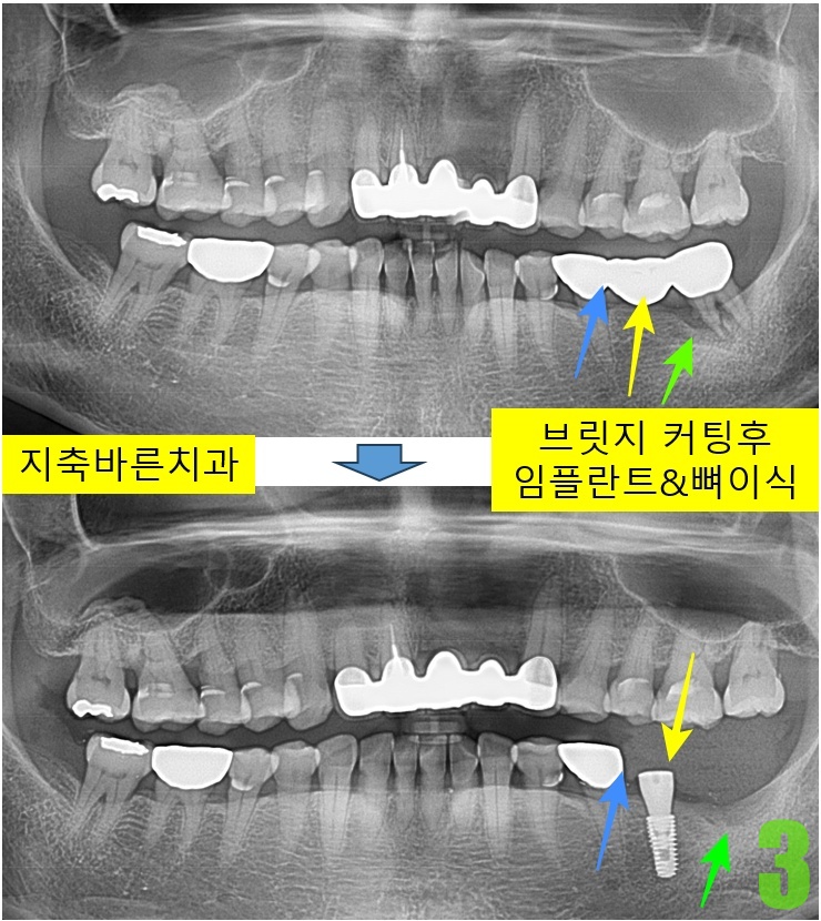 3. 임플 식립.jpg