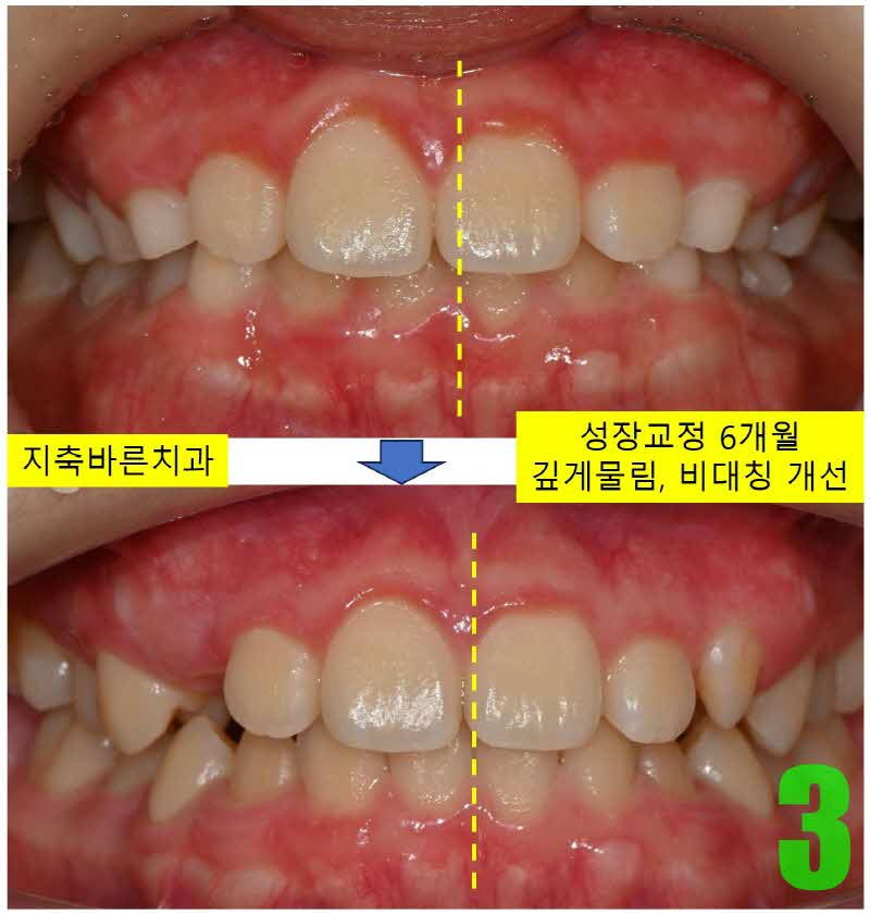 3. 6개월 정면_s.jpg