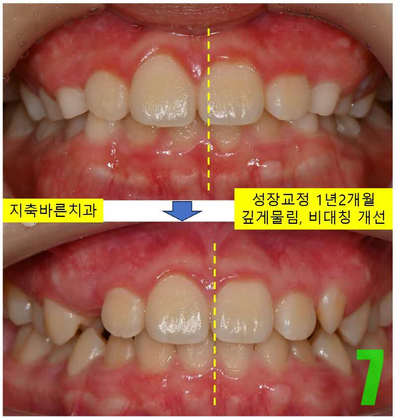 7. 1년 2개월 IO_s.jpg