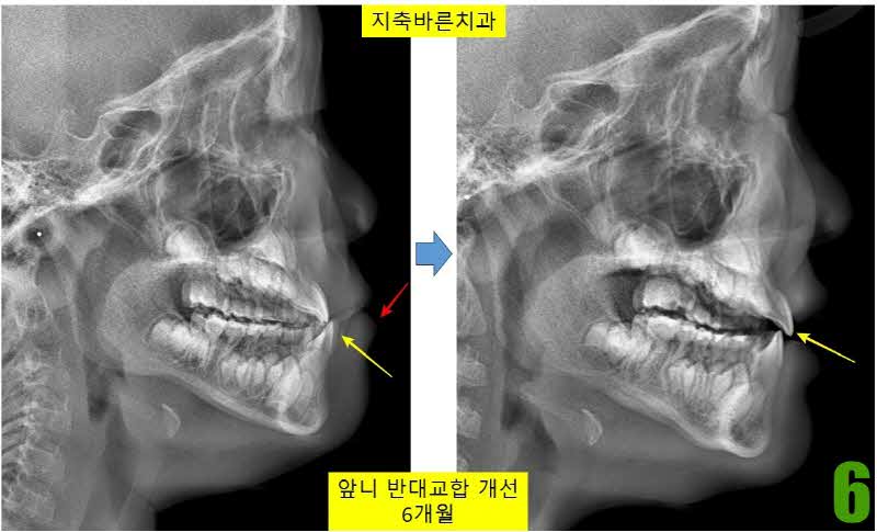 6. 치료 6개월 셉_s.jpg