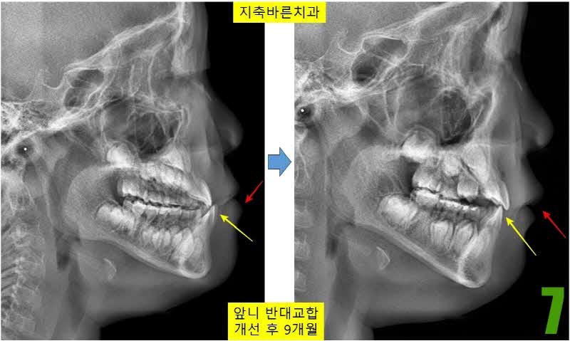 7. 하악성장 obs 9개월_s.jpg