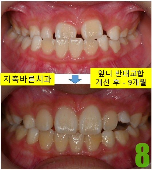 8. 하악성장 obs 9개월 정면.jpg