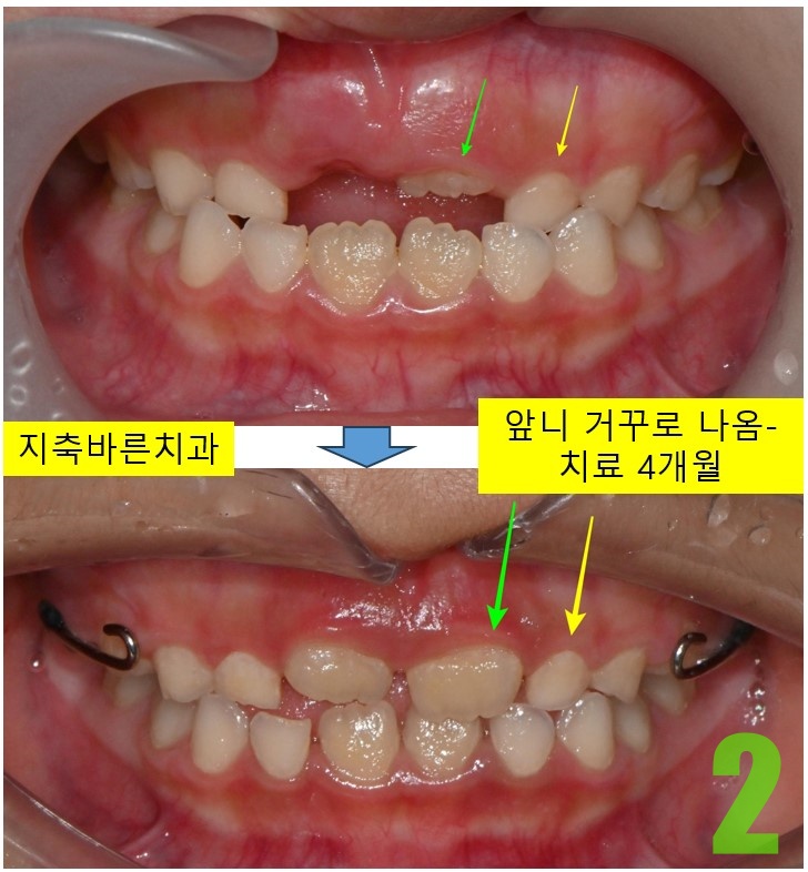 2. 치료전후 정면.jpg