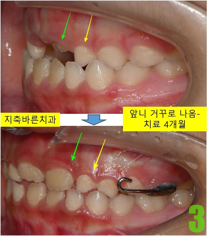 3. 치료전후 측면.jpg