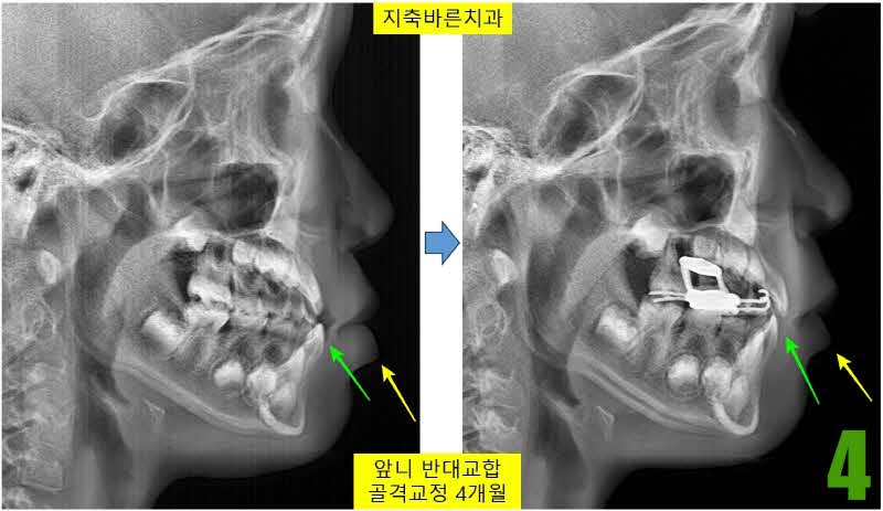 4. 치료전후 셉_s.jpg