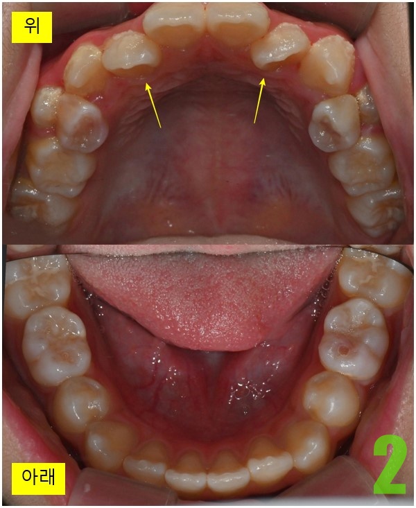 2. 초진 교합면.jpg