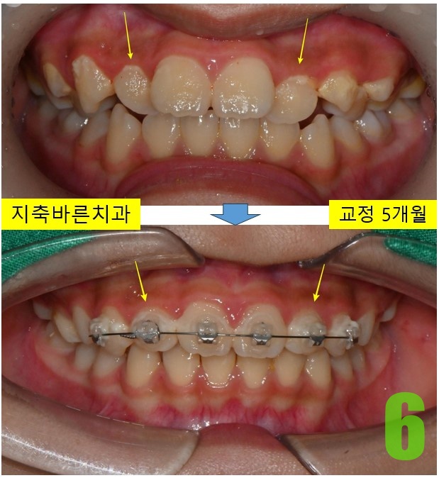 6. 치료 5개월 정면.jpg