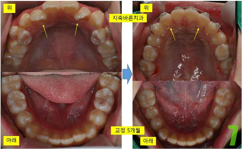 7. 치료 5개월 교합면_s.jpg