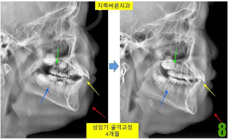 8. 골격교정 4개월_s.jpg