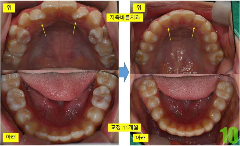 10. 골격교정 4개월_s.jpg