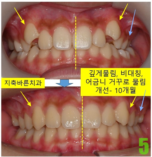 5. 치료 10개월 정면.jpg